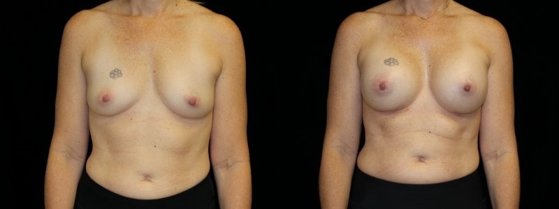 Breast Augmentation