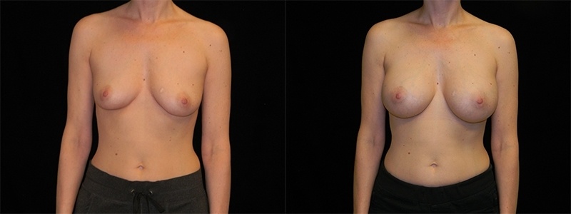 Breast Augmentation