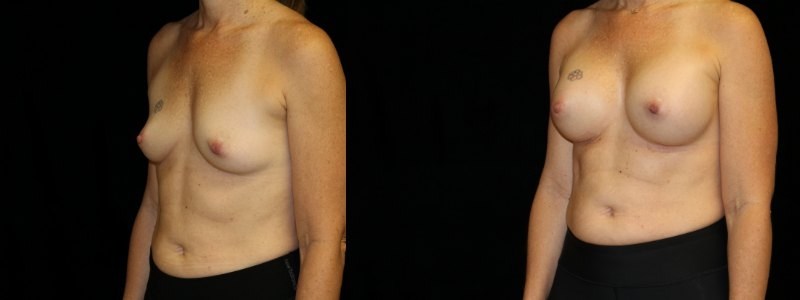Breast Augmentation