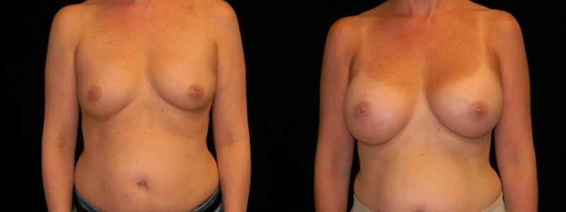 Breast Augmentation