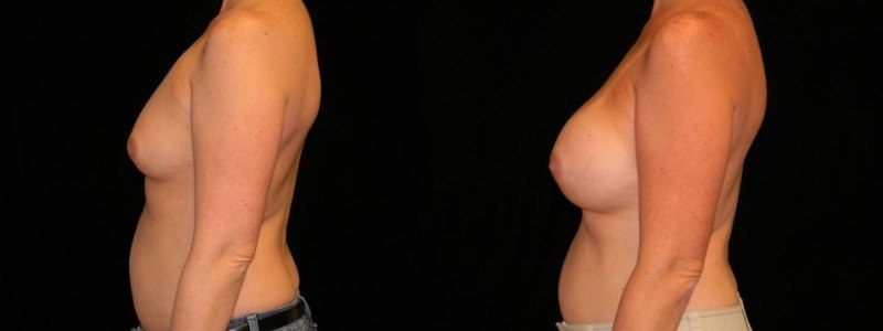 Breast Augmentation