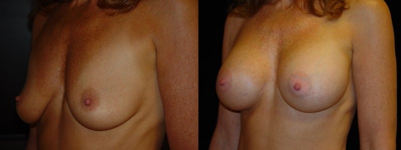 Breast Augmentation