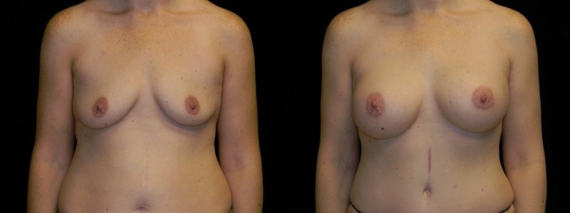 Breast Augmentation
