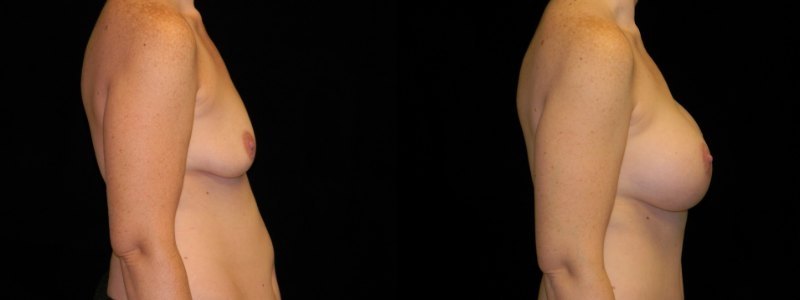 Breast Augmentation