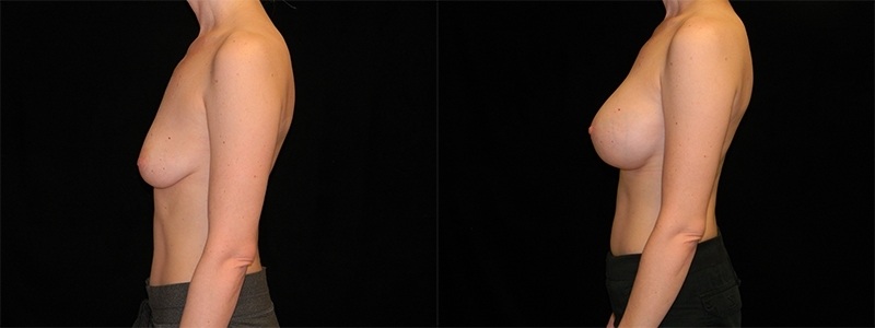 Breast Augmentation