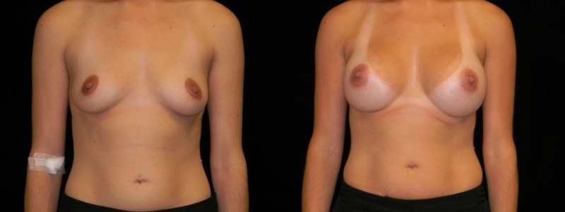 Breast Augmentation