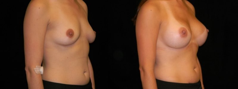 Breast Augmentation
