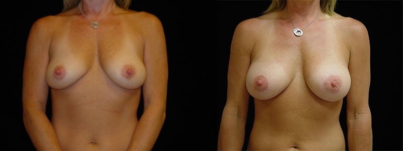 Breast Augmentation