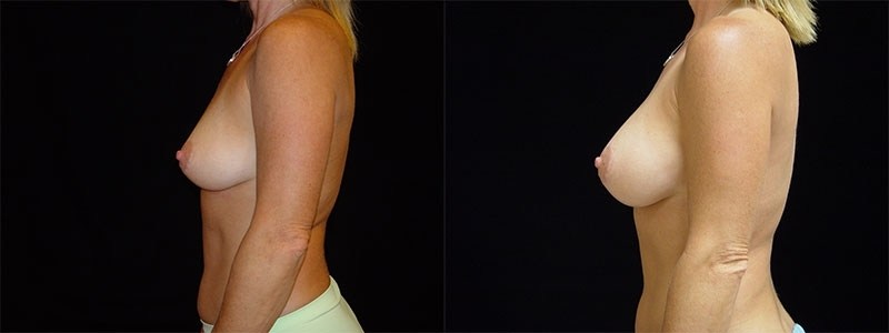 Breast Augmentation