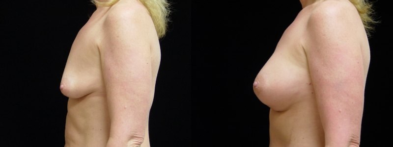Breast Augmentation, Tummy Tuck and Liposuction