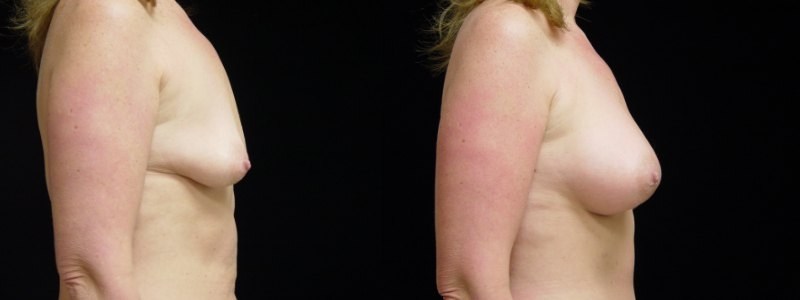 Breast Augmentation, Tummy Tuck and Liposuction