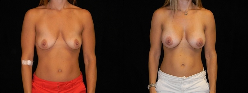 Breast Augmentation