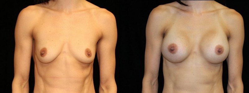Breast Augmentation