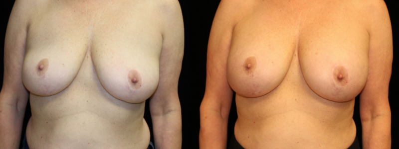 Breast Augmentation after a breast lift