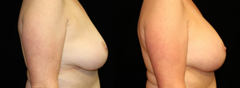 Breast Augmentation after a breast lift