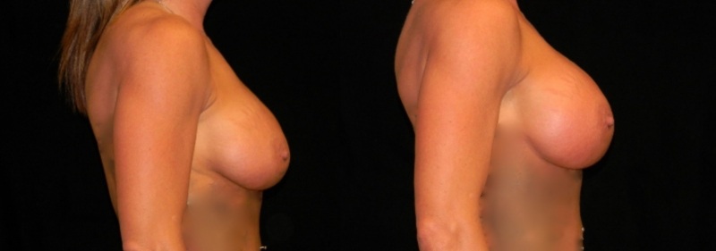 Breast Augmentation