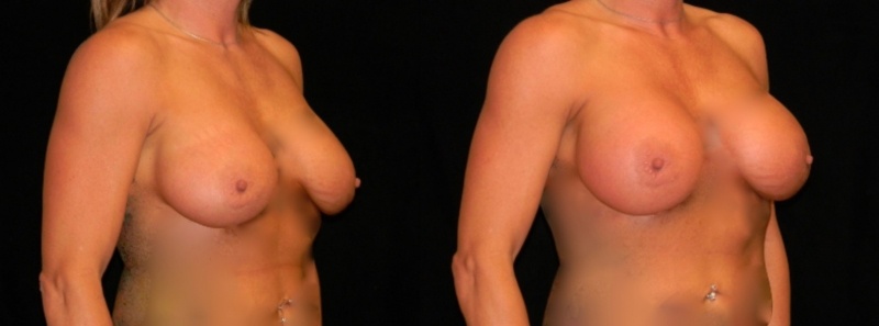 Breast Augmentation