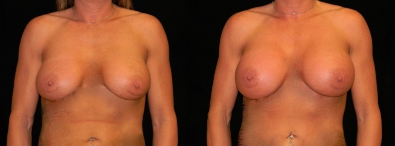 Breast Augmentation