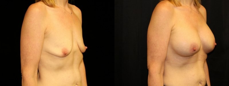 Breast Augmentation