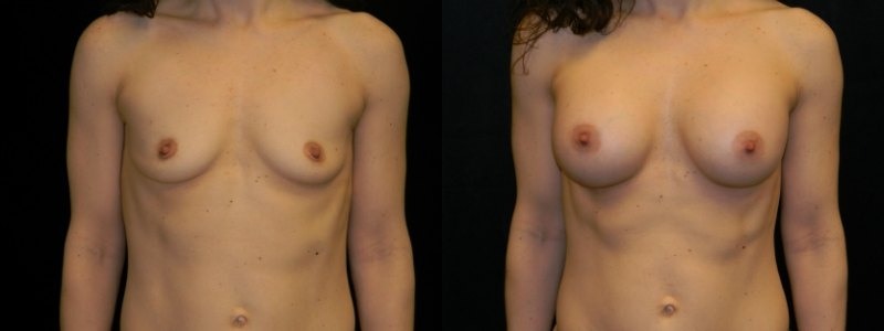 Breast Augmentation