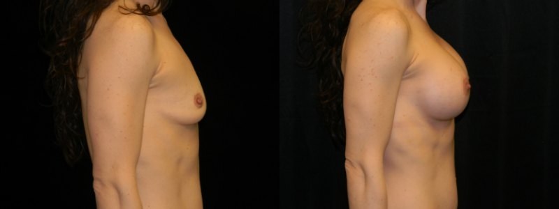 Breast Augmentation