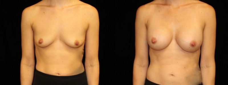 Breast Augmentation