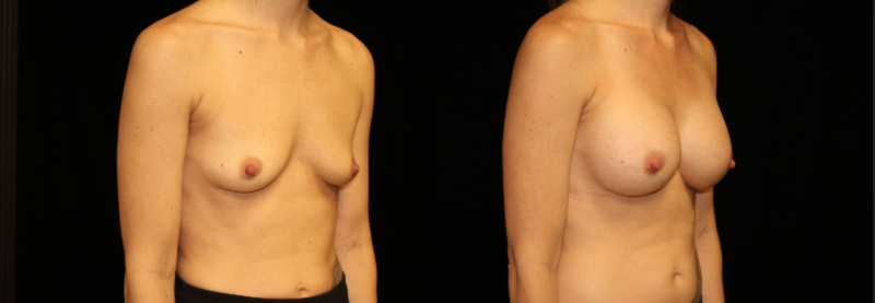 Breast Augmentation