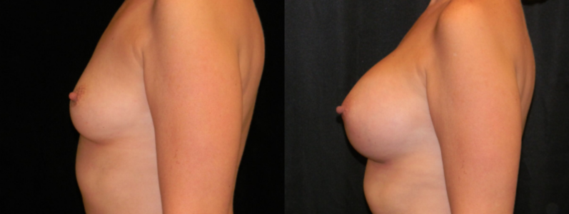 Breast Augmentation