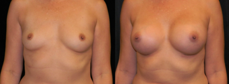 Breast Augmentation