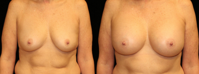 Breast Augmentation
