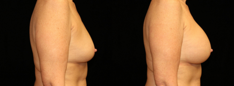 Breast Augmentation