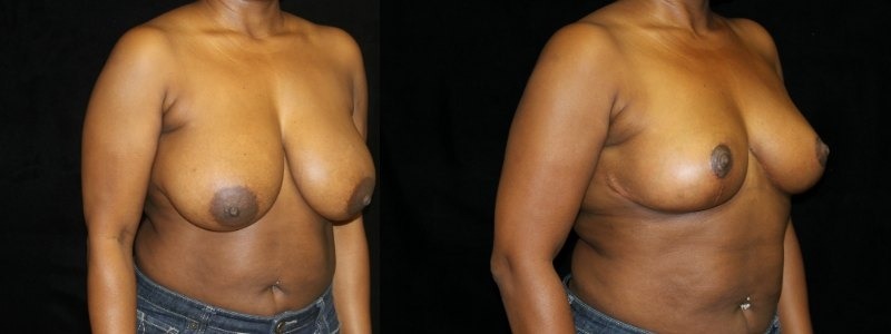 Breast Reduction