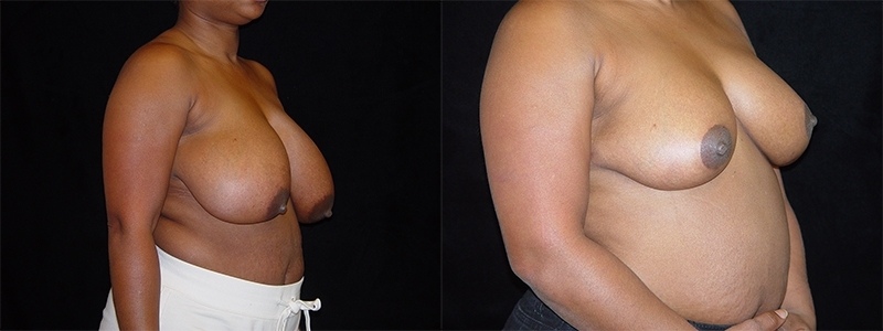 Breast Reduction