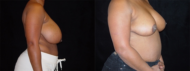 Breast Reduction