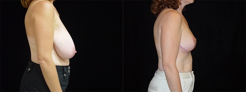 Breast Reduction