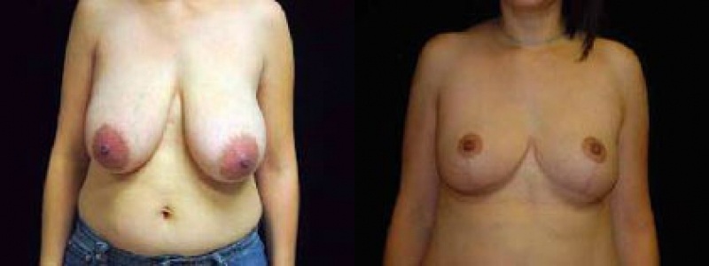Breast Reduction