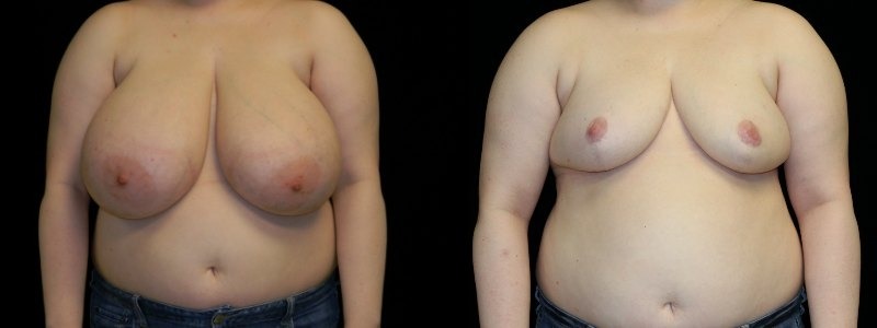 Breast Reduction