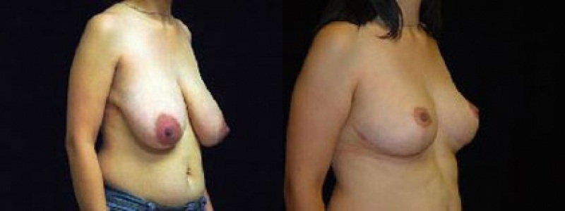 Breast Reduction