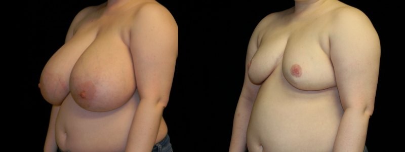 Breast Reduction