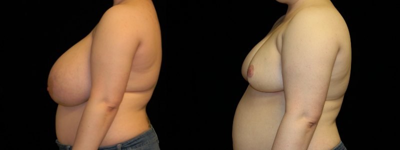 Breast Reduction