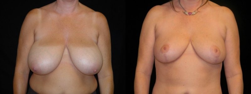 Breast Reduction