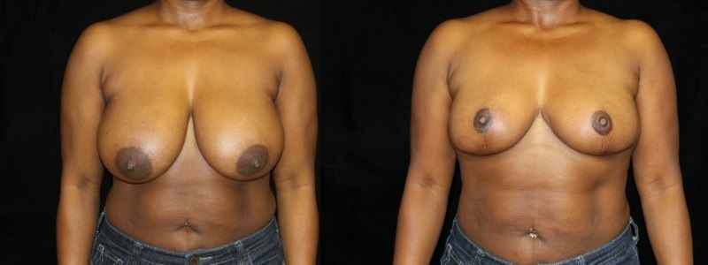 Breast Reduction