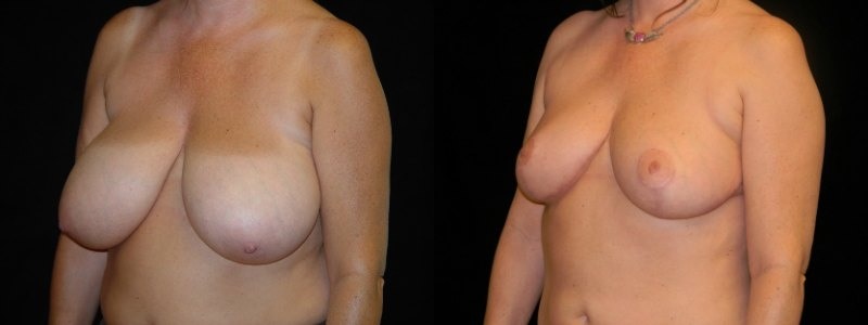 Breast Reduction