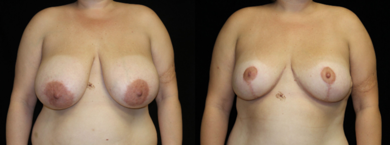 Breast Reduction