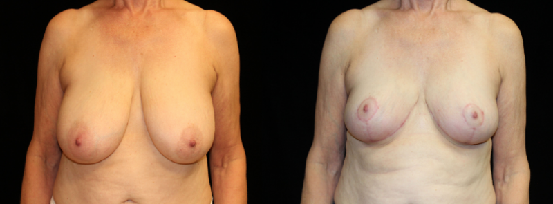 Breast Reduction