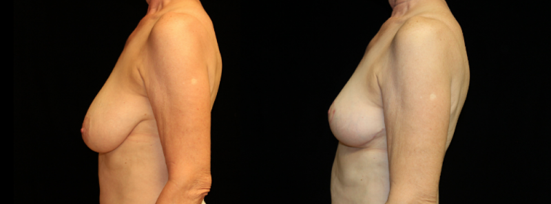 Breast Reduction