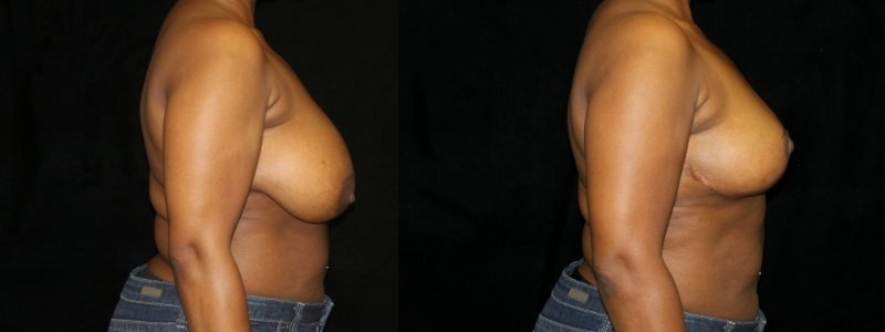 Breast Reduction
