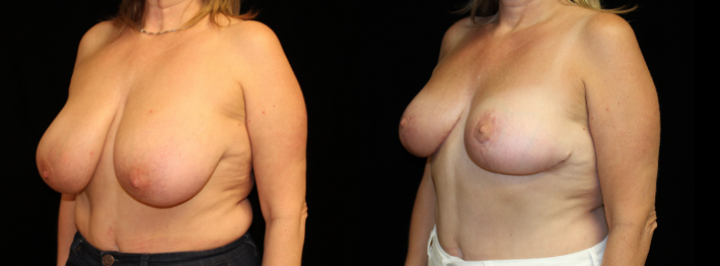 Breast Reduction