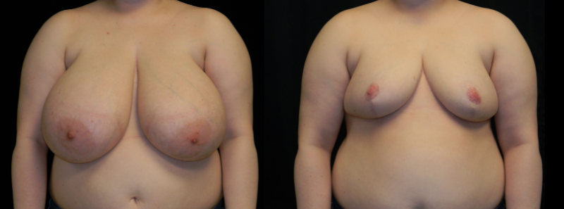 Breast Reduction
