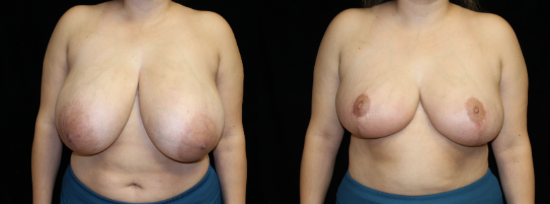 Breast Reduction